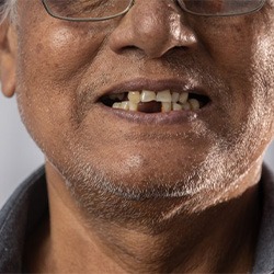 Man has missing teeth